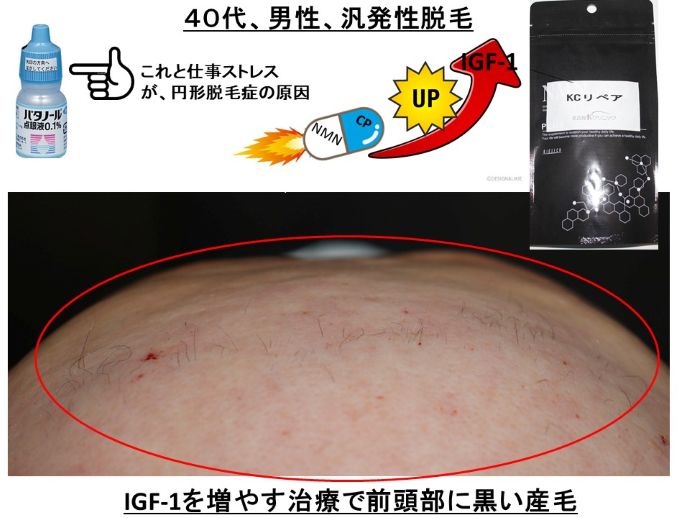 円形脱毛症　病院